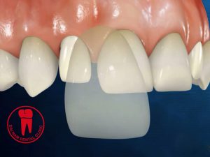 The method use porcelain teeth to improve uneven teeth is extremely popular