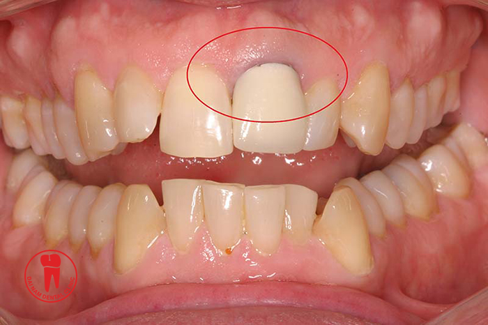 The type of metal porcelain teeth oxidized irritate the gums and soft tissues, causing halitosis