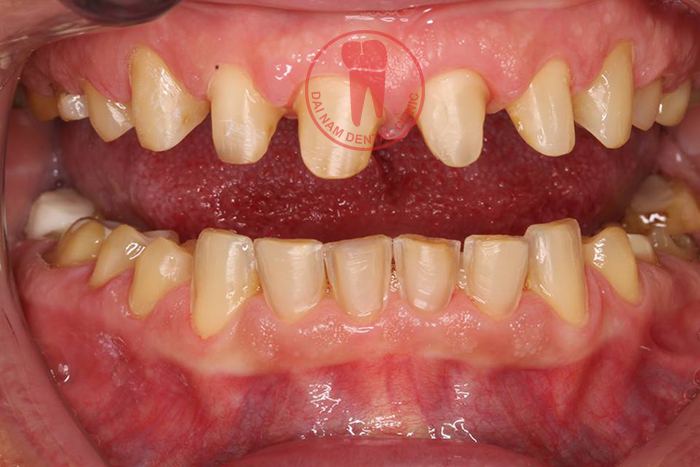 The teeth grinding too deep into the pulp, affecting the pulp, make teeth brittle and must be wrapped again