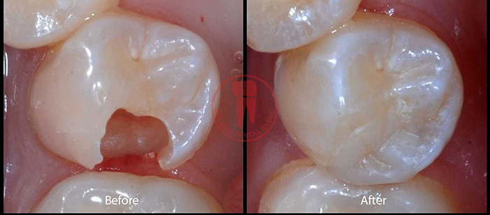 Caries with small deep hole, not too serious and pulp still in good condition