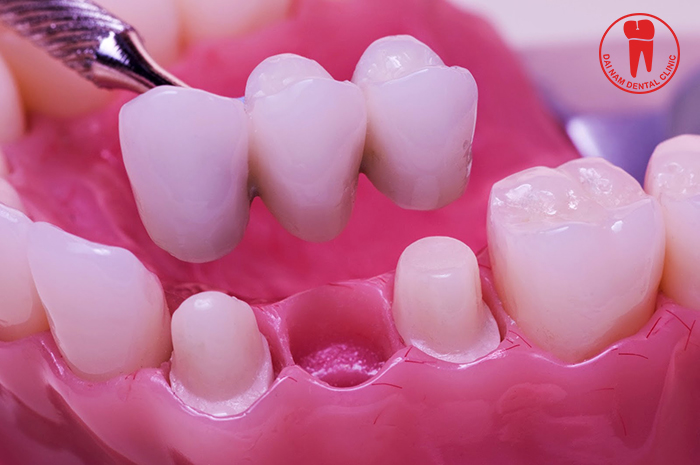 Porcelain tooth bridge