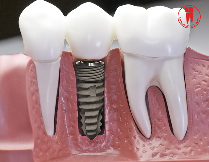 The Implant will be the most optimal method because it can overcome the disadvantages completely