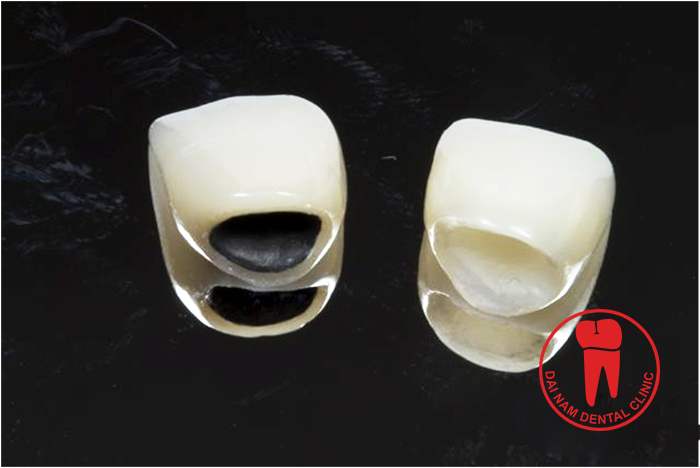 All- Porcelain teeth and Porcelain Metal