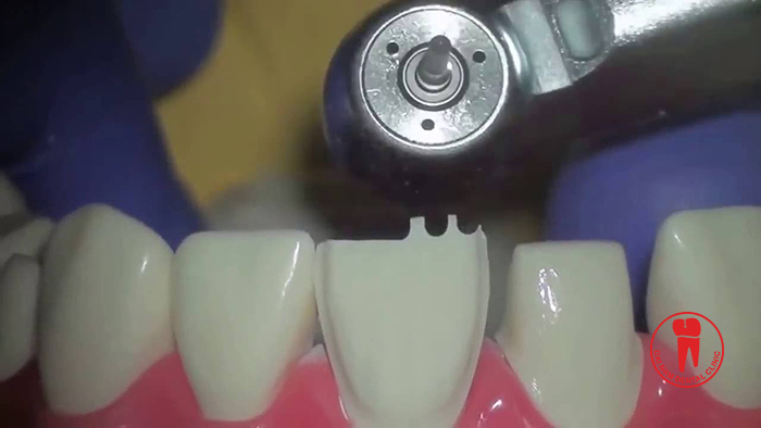 Just grinding at a level very few so not affect the tooth structure