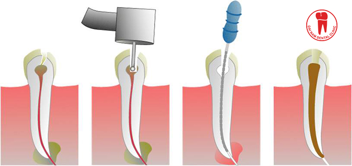 The root canal treatment process at the Dai Nam Dental