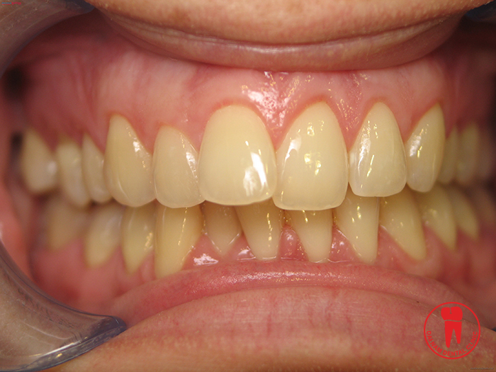 Teeth Whitening applies to all cases of tooth staining by food contaminated color