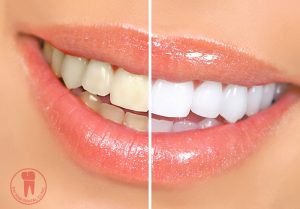 Before and After making Teeth whitening