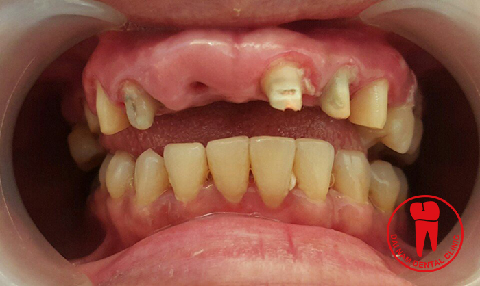There are many causes of tooth loss, such as do not take care of your teeth properly lead to tooth decay