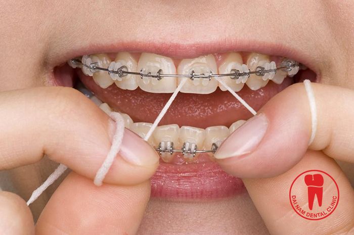 With braces, your teeth will be more difficult to clean