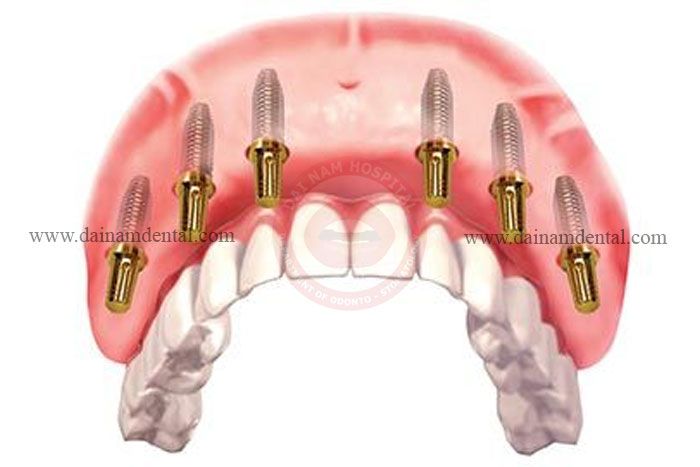 All on six - The best solution for the loss of full teeth