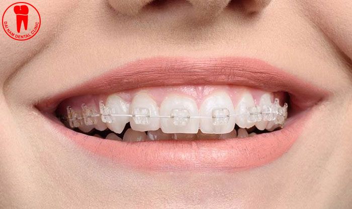 CERAMIC-BRACES